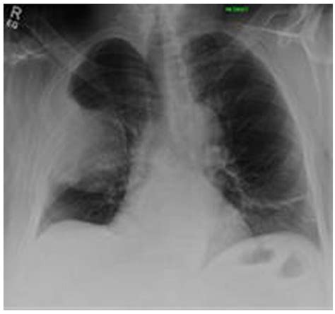 Amyloidoma And Plasmacytoma Presented As A Solitary Lung Nodule In A