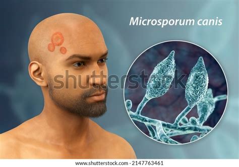 Microsporum Canis Fungal Infection On Mans Stock Illustration ...