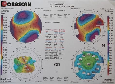 Topography Guided Prk In A Penetrating Keratoplasty Ocular