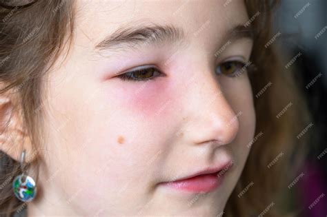 Premium Photo | A red swollen eyelid on a child face in closeup is an allergy to an insect bite ...