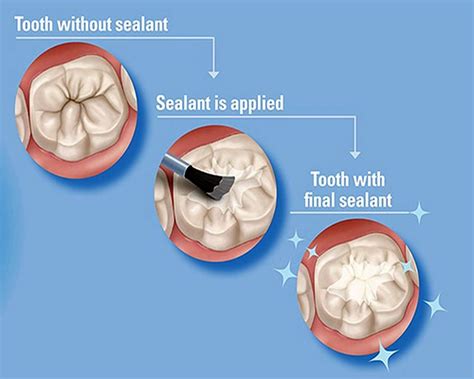 How To Apply Clinpro Sealant Step By Step OdontoVida