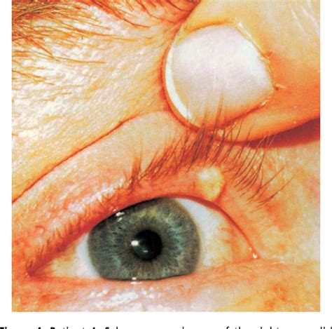 Figure 1 From Sebaceous Carcinoma Of The Eyelids Treated By Mohs Micrographic Surgery Report Of