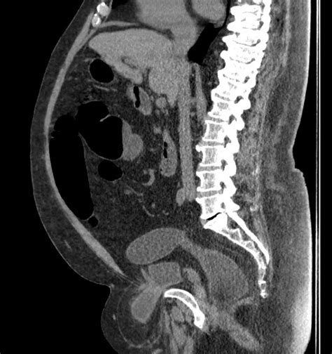 Urinary Bladder Hernia Image Radiopaedia Org