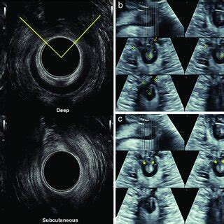 Endoanal Ultrasound A And Transperineal Tomographic Ultrasound B C