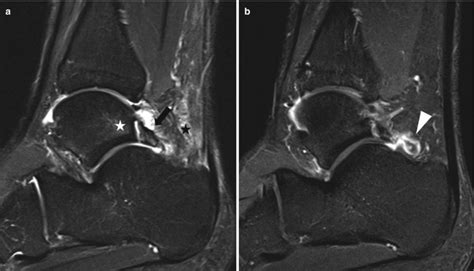 Fig 8 12 [posterior Ankle Impingement Os Trigonum