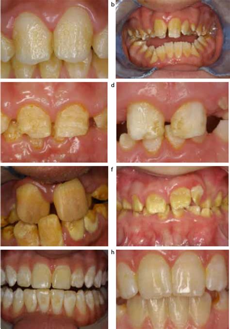 AI Phenotypes A D Hypoplastic Type E F Dysmineralized