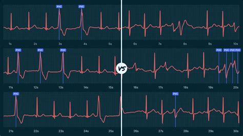 Accelerated Idioventricular Rhythm vs Ventricular Tachycardia on Your Watch ECG | Qaly