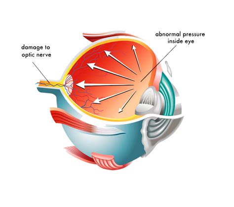 Dr Thiru's Eye Clinic Sight Far Life | Glaucoma