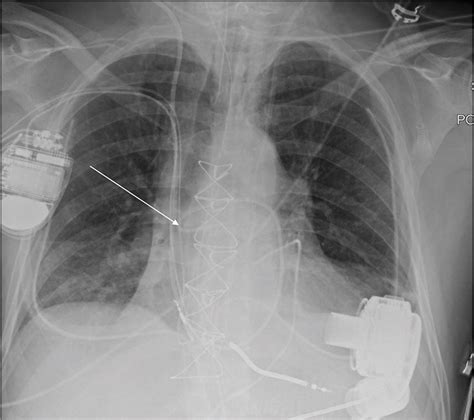 Malpositioned Lines And Tubes On Chest Radiograph A Concise Pictorial