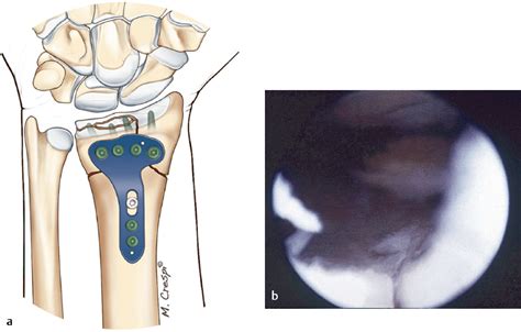 Chapter 17 Arthroscopically Assisted Fixation Of Intra Articular Distal