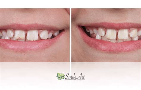 Бондинг Архив ортодонтска практика Smile Art. Лечение на криви зъ