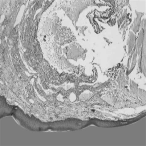 Differential Diagnosis Of Mucocele Occurring On Most Common Site Lower