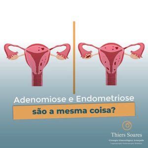 Endometriose E Adenomiose S O A Mesma Coisa Dr Thiers