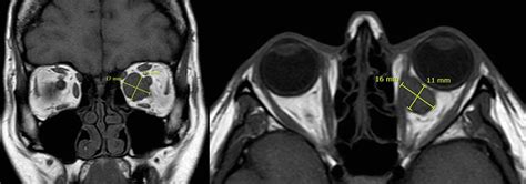 Resection Of Medial Orbital Tumours Via Lateral Orbitotomy And