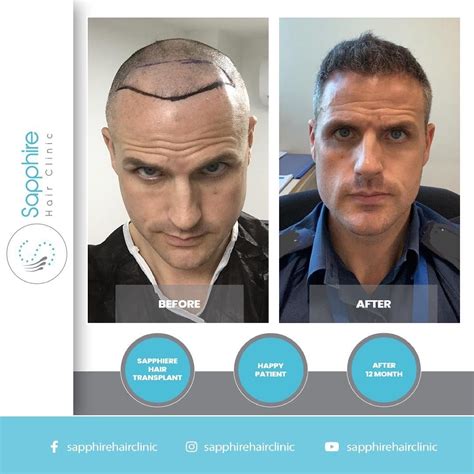 Hair Transplant Istanbul Natural Looking Results At Affordable Prices