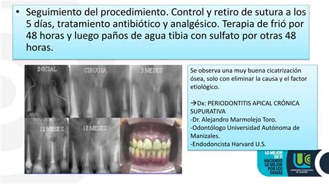 Absceso Apical Agudo Y Crónico Ppt