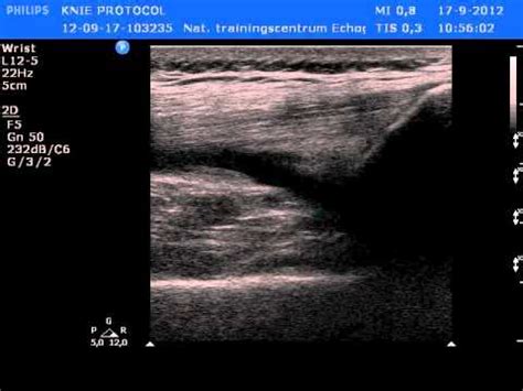 Knee Effusion Ultrasound