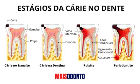 Dente inflamado (Pulpite): Causas, sintomas e como tratar - MaisOdonto