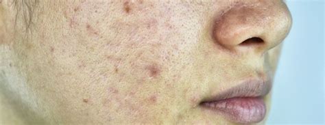 A Comprehensive Guide To Laser Acne Scar Treatment Pulse Light Clinic