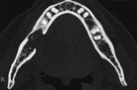 Osteoradionecrosis Oral And Maxillofacial Surgery Clinics