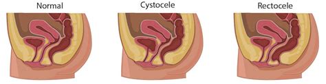 Pelvic Exam I External Genitalia Anatomy And Exam Procedure Physical