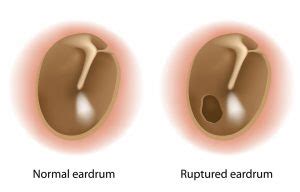 Eardrum Rupture - Otolaryngology Specialists of North Texas