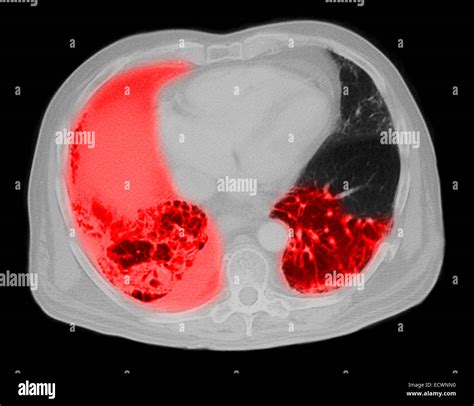 Legionella Pneumonia Ct Scan