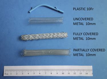 Biliary Stents For Palliation Of Obstructive Jaundice Choosing The