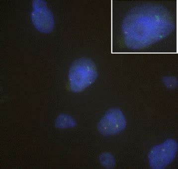 Coexistence of fused- and split-signals of the FUS gene. FISH analysis... | Download Scientific ...