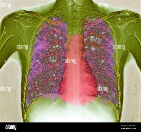 Tuberculosis Coloured X Ray Of A Patients Chest Showing Disseminated