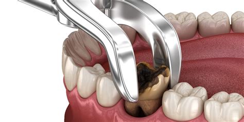 Tooth Extraction - Cure Voyage