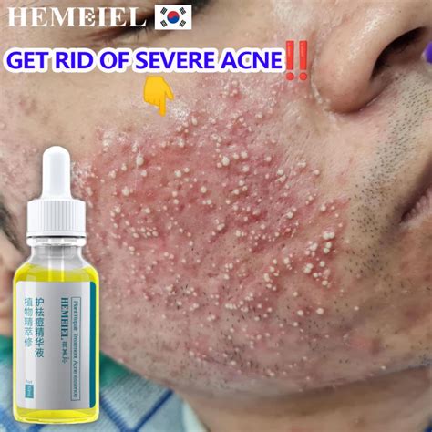 Hemeiel Oxecure Acnepimple Eraser Quick Fxanti Acne And Pimples Lazada Ph