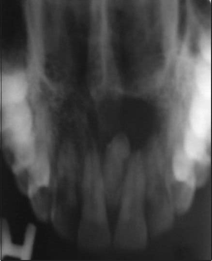 Maxillary Occlusal Radiograph Showing Well Defined Corticated