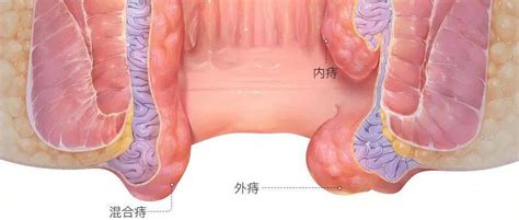 带你走出痔疮的误区患者内痔症状