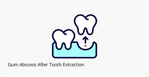 Gum Abscess After Tooth Extraction Causes And Treatment Share Dental Care