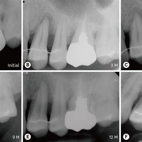 Anterior Periapical Radiograph