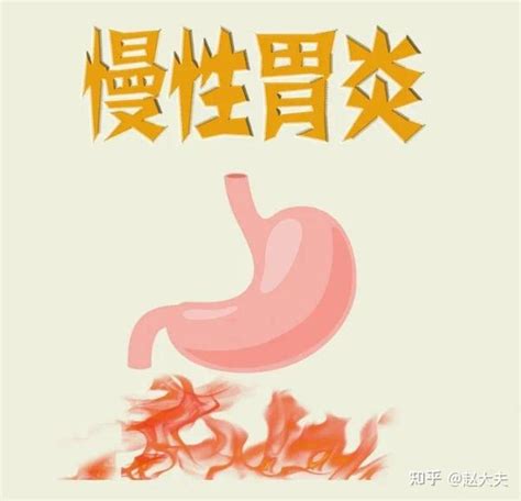 艾灸穴位——慢性胃炎 知乎