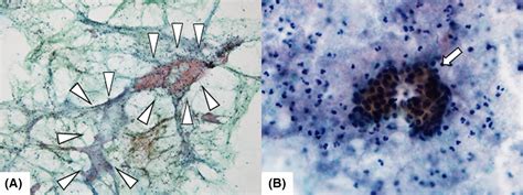 A Case Report Of Kuttner Tumor Mimicking A Malignant Tumor Leading To