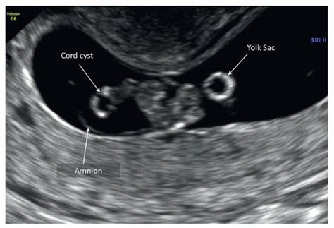 Placenta and Umbilical Cord | Radiology Key