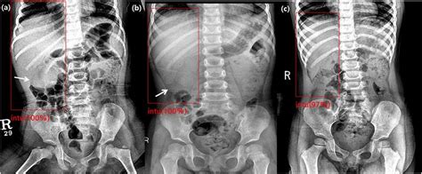 Labeled Abdominal X Ray