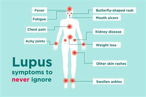 Lupus Signs and Symptoms: How to Tell If You Could Have Lupus