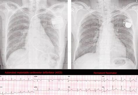 Automated Implantable Cardioverter Defibrillator AICD and Permanent ...