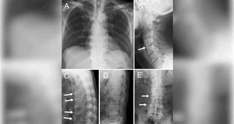 Espalda Espondilitis Anquilosante Se Presenta Con Rara Entesitis En