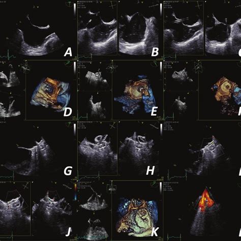 Intracardiac Echocardiography (ICE) Guidance for Left Atrial Appendage ...