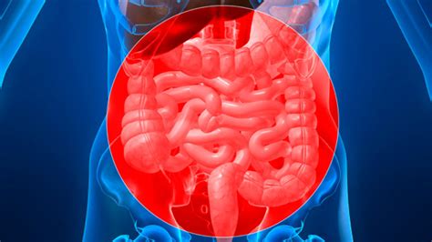 Ischemic Colitis: Causes, Symptoms, and Diagnosis