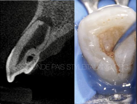 Management of Type II dens invaginatus - Style Italiano Endodontics