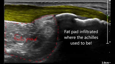 Haglund Deformity Versus Haglund Syndrome Youtube