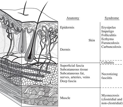 Necrotizing Soft Tissue Infection Anesthesia Key