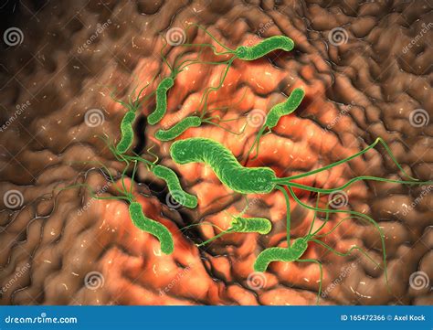 Gastritis Helicobacter Pylori Bacteria Damaging Mucus Layer Medically