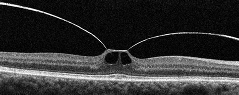 Diagnosing Vitreomacular Disorders With Oct Pacific Cataract And